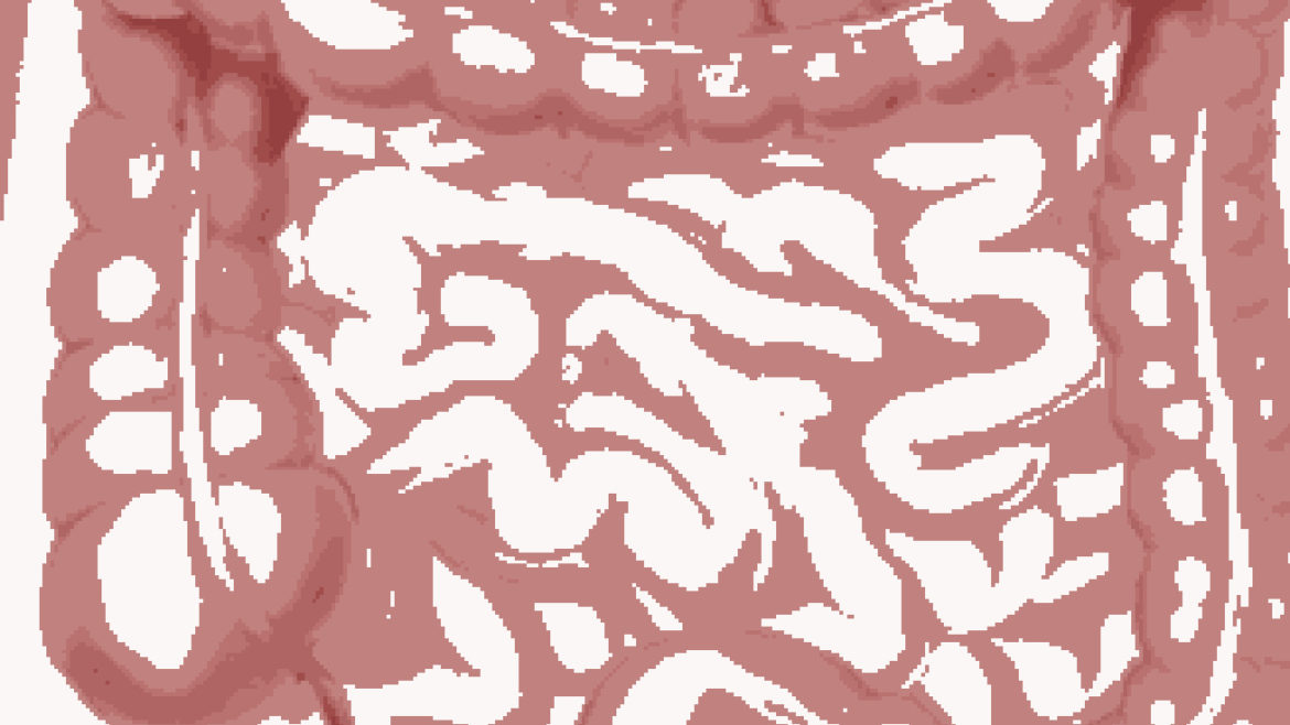 Colon on Vacation Constipation